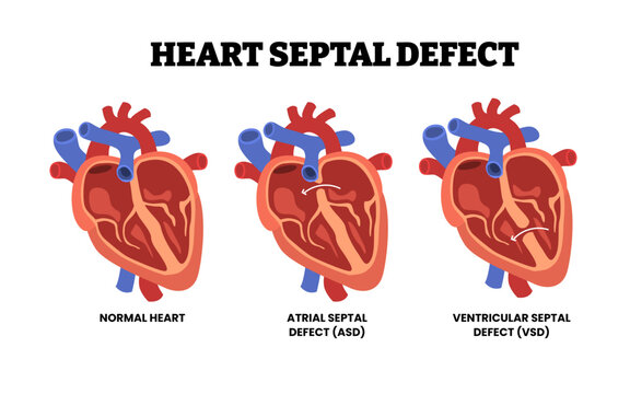 Heart Septal Defect, educational medical poster design healthcare scheme, internal organ. cardiovascular disease, heart complication. Labeled Atrial Septal Defect (ASD),Ventricular Septal Defect (VSD)