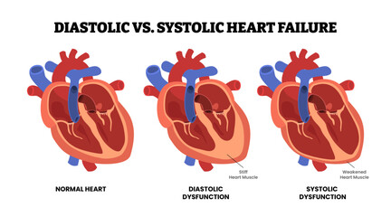 Diastolic VS Systolic Heart Failure, educational medical poster design healthcare scheme, internal organs, cardiovascular disease, heart complication. Labeled stiff and weakened heart muscle.