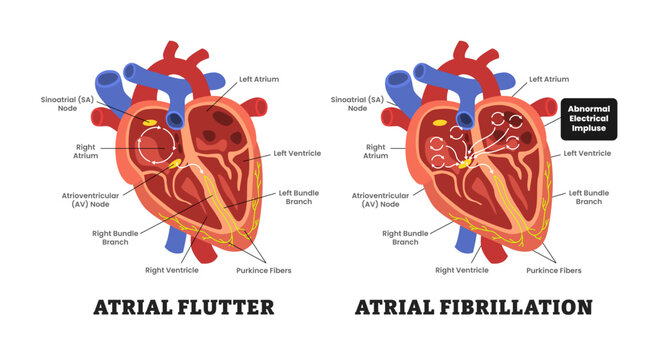 Heart Atrial Fibrillation VS Atrial Flutter, educational medical poster design healthcare scheme, internal organs, cardiovascular disease, heart complication. Labeled abnormal electrical impulse.