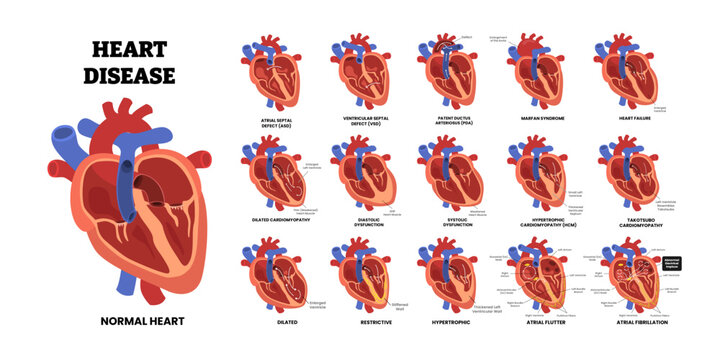 Heart Disease Set, educational medical poster design healthcare scheme, internal organs, labeled Atrial Fibrillation, Atrial Flutter, Atrial Septal Defect ASD, Diastolic Dysfunction Heart Failure.