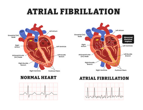 Heart atrial fibrillation vs Normal Heart, educational medical poster design healthcare scheme, internal organs. Labeled ablation catheter ablation, regular irregular heartbeat rhythm ECG.