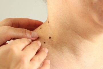 Doctor examining woman's moles on light grey background, closeup