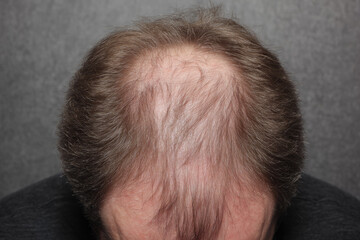 Fototapeta premium Man with thinning hair is viewed from above, highlighting hair loss against gray background. image focuses on top of head, emphasizing pattern of hair thinning