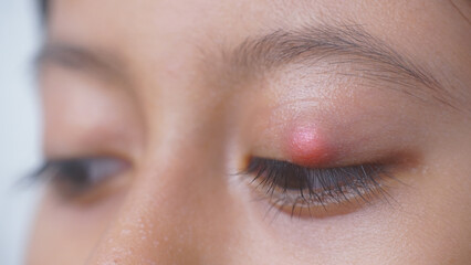 Young woman with eye infection, sty, hordeolum. Concept of health, disease and treatment