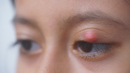 Young woman with eye infection, sty, hordeolum. Concept of health, disease and treatment