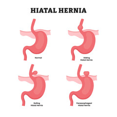 Different types of hiatal hernia stomach disease, educational medical poster design healthcare scheme, human stomach internal organs. Labeled sliding, rolling, paraesophageal. Diaphragm opening.