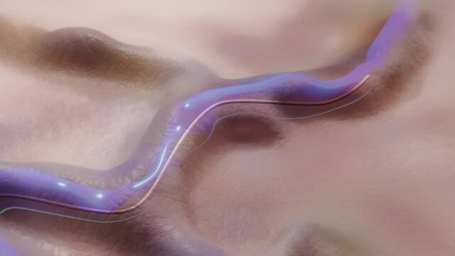 Endovenosus Thermal Ablation