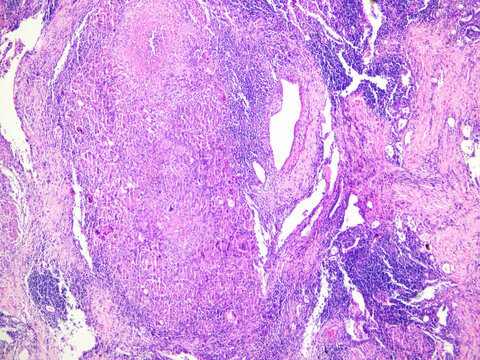Tuberculosis is an infectious disease of respiratory system, which is caused by mycobacterium tuberculosis, and its typical pathological feature is necrotizing granulomatous inflammation.Magnify 40x.
