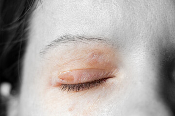 Removed papillomas on the eyelid of a young girl after cauterization, treatment