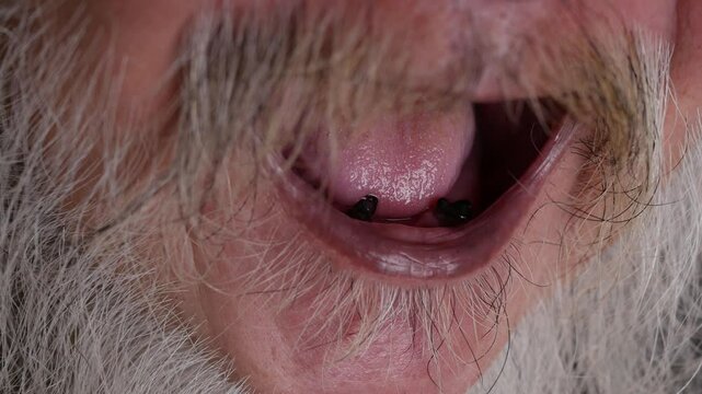 Dental problem bad teeth loss. decayed tooth on old age man.