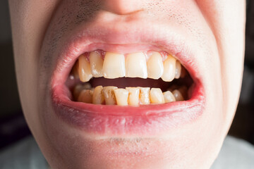 Yellow and crooked teeth covered with tartar and plaque, dental issues and oral health concept