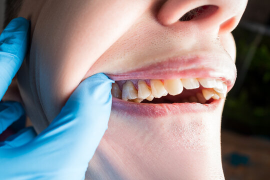 Gingival recession, yellow and crooked teeth covered with tartar and plaque, dental issues and oral health concept
