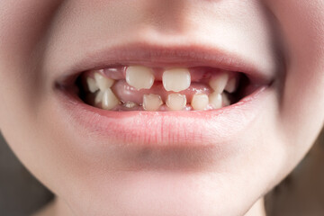 Obraz premium Losing primary teeth or milk tooth change, dental issues and oral health concept