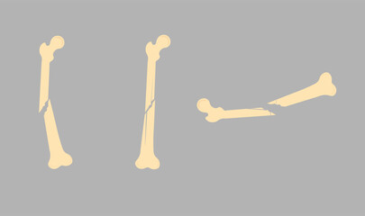 Bone fracture vector illustration