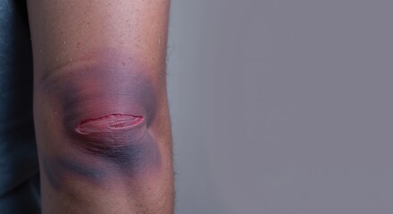Fototapeta premium Wounded elbow with bruising and cut on a gray background 
