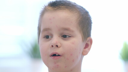 A child with a skin condition chickenpox being photographed in a bright and cheerful environment