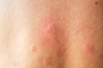 Fototapeta premium Young asian man itching and scratching on his back from allergic itchy dry skin eczema dermatitis insect bites