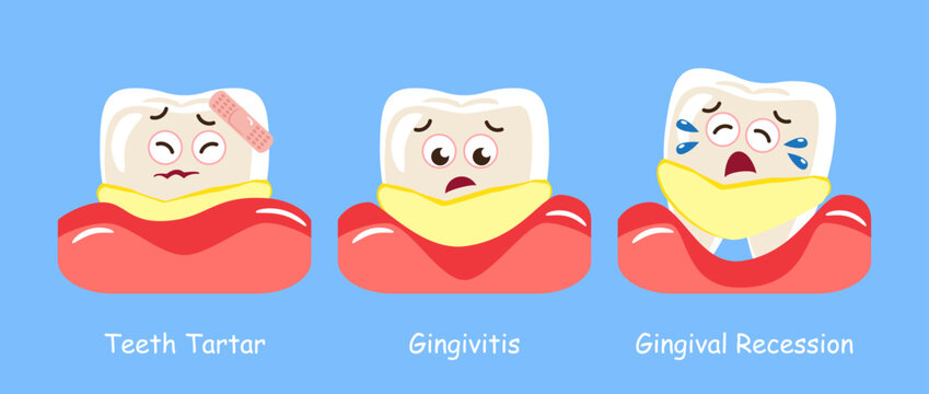 Progression of periodontitis . Teeth tartar, gingivitis and gingival recession . Cartoon characters . Vector .