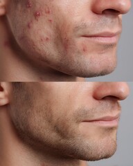 Naklejka premium before and after male acne treatment, visible skin improvement, skincare transformation,