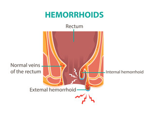 Hemorrhoids inflammation. Cross-section of the rectum or anal canal