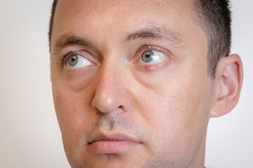 Obraz premium Man's eyes with pus redness like chalazion caused by blocked sebaceous glad on lower eyelid. Hordeolum. Viral infection