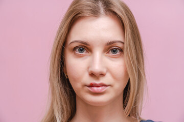 Closeup on virus herpes on lip of young woman with pink background. Herpes blisters