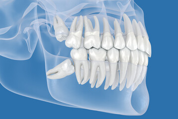Fototapeta na wymiar Impaction of Wisdom tooth. Dental 3D illustration