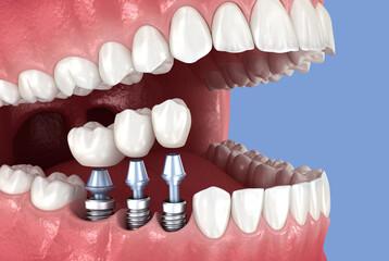 Tooth crowns placement over 3 implants. Dental 3D illustration