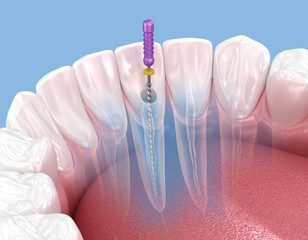 Fototapeta na wymiar Endodontic root canal treatment process. Medically accurate tooth 3D illustration.