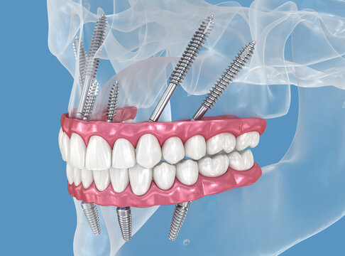 Maxillary prosthesis supported by zygomatic implants. 3D illustration