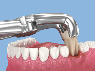 Tooth extraction, damaged by caries. Dental 3D illustration