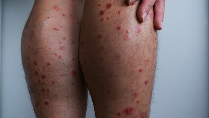 Fototapeta premium A man with chronic small plaque Psoriasis on his legs.