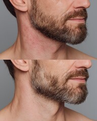 Fototapeta premium sunburn recovery for men, before sun damage, in progress applying aftersun, after clear healthy skin