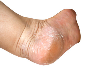 Fototapeta premium Close-Up of Dry Cracked Foot Skin with Dryness Issues Visible