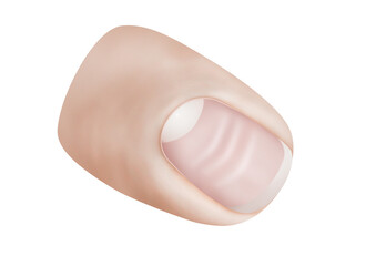 Beau’s Lines on fingernail with deep horizontal lines, associated with interrupted nail growth due to systemic illness or trauma. Great for nail technician courses and diagnostic guides.