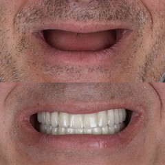 Treatment of tooth loss with jawbone implants. Full arch denture prosthesis on multiple dental...