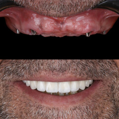 Obraz premium Full-arch denture prosthesis with dental implants placed in the jawbone. Full arch implant treatment with porcelain prosthesis. Dental before after and smile makeover.