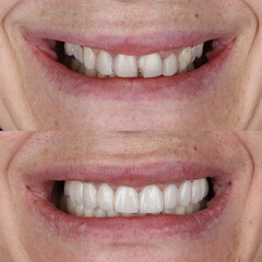 Fototapeta premium Smile design treatment with cosmetic dentistry. Laminate veneers and zirconia porcelain for a new smile through dental design. Dental before after and smile makeover.
