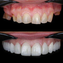 Smile design treatment with cosmetic dentistry. Laminate veneers and zirconia porcelain for a new smile through dental design. Dental before after and smile makeover.