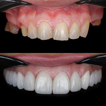 Smile design treatment with cosmetic dentistry. Laminate veneers and zirconia porcelain for a new smile through dental design. Dental before after and smile makeover.
