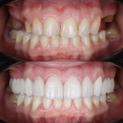 Smile design treatment with cosmetic dentistry. Laminate veneers and zirconia porcelain for a new smile through dental design. Dental before after and smile makeover.