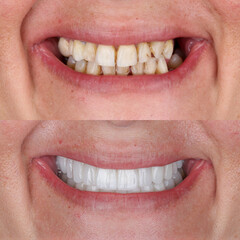 Full mouth porcelain crown treatment in cosmetic dentistry. Correction of crooked and deformed teeth with porcelain veneers. Dental before after and smile makeover.

