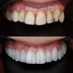 Full mouth porcelain crown treatment in cosmetic dentistry. Correction of crooked and deformed...