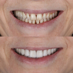Full mouth porcelain crown treatment in cosmetic dentistry. Correction of crooked and deformed...