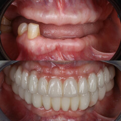 Full-arch denture prosthesis with dental implants placed in the jawbone. Full arch implant treatment with porcelain prosthesis. Dental before after and smile makeover.

