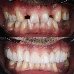 Full mouth porcelain crown treatment in cosmetic dentistry. Correction of crooked and deformed teeth with porcelain veneers. Dental before after and smile makeover.

