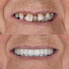 Full-arch denture prosthesis with dental implants placed in the jawbone. Full arch implant...