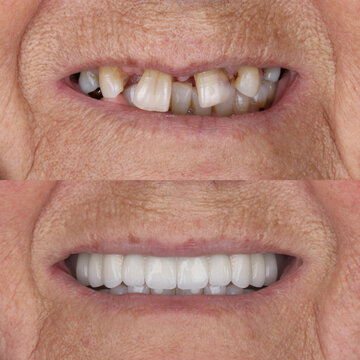 Full-arch denture prosthesis with dental implants placed in the jawbone. Full arch implant treatment with porcelain prosthesis. Dental before after and smile makeover.

