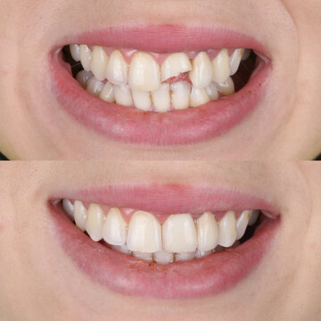 Treatment of deformed and discolored teeth with composite filling in dental care. Filling treatment for decayed teeth. Dental before after and smile makeover.

