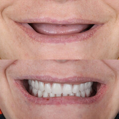 Obraz premium Full-arch denture prosthesis with dental implants placed in the jawbone. Full arch implant treatment with porcelain prosthesis. Dental before after and smile makeover.